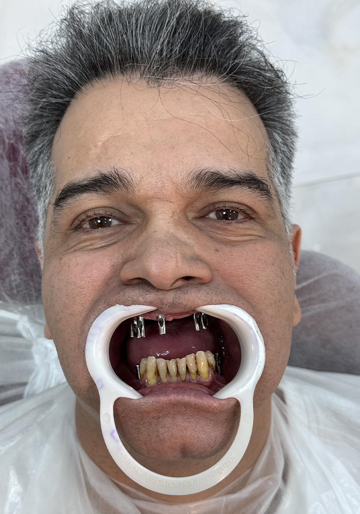 جراحی ایمپلنت