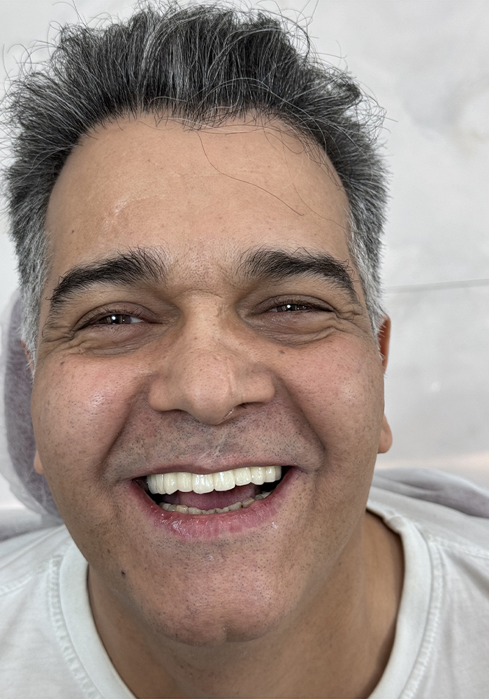 جراحی ایمپلنت