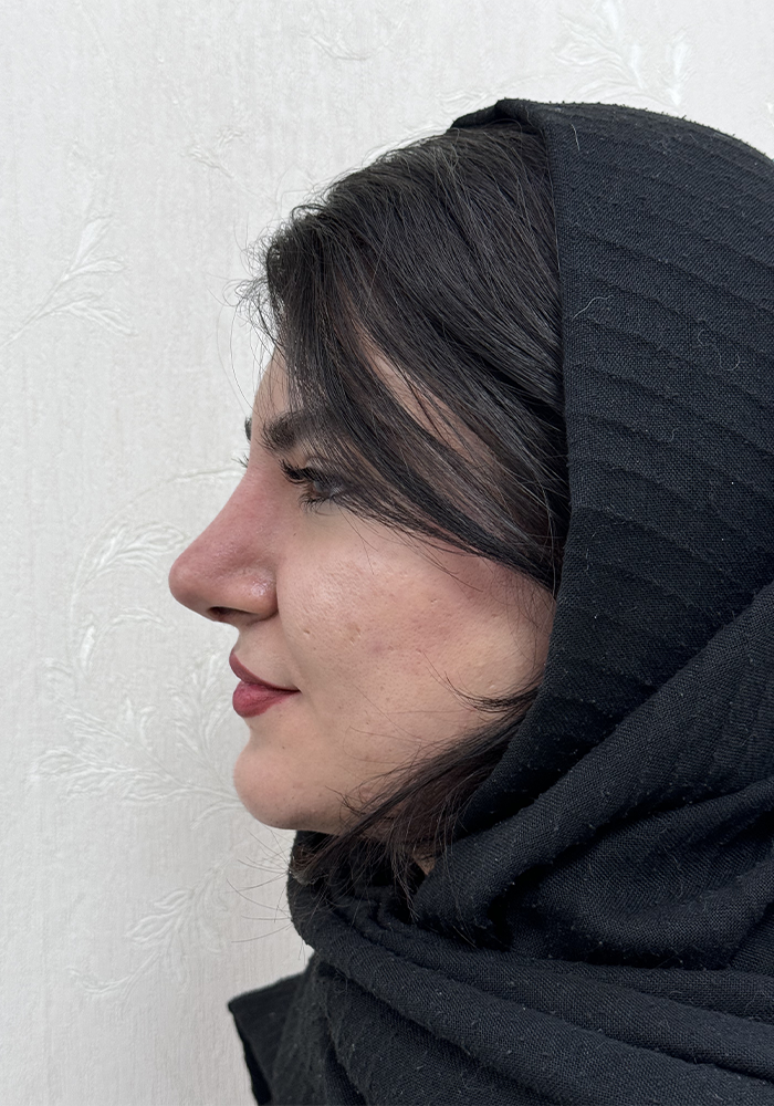 جراحی زیبایی بینی (رینوپلاستی)