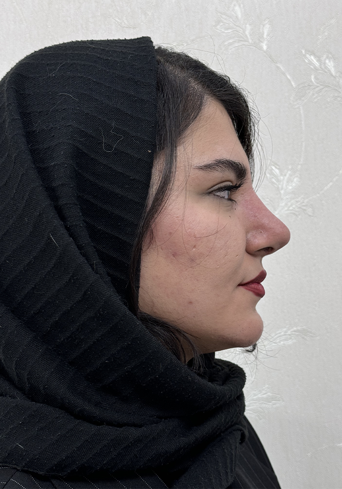 جراحی زیبایی بینی (رینوپلاستی)