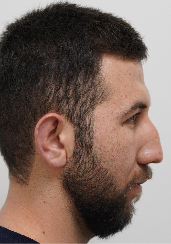 جراحی زیبایی بینی (رینوپلاستی)