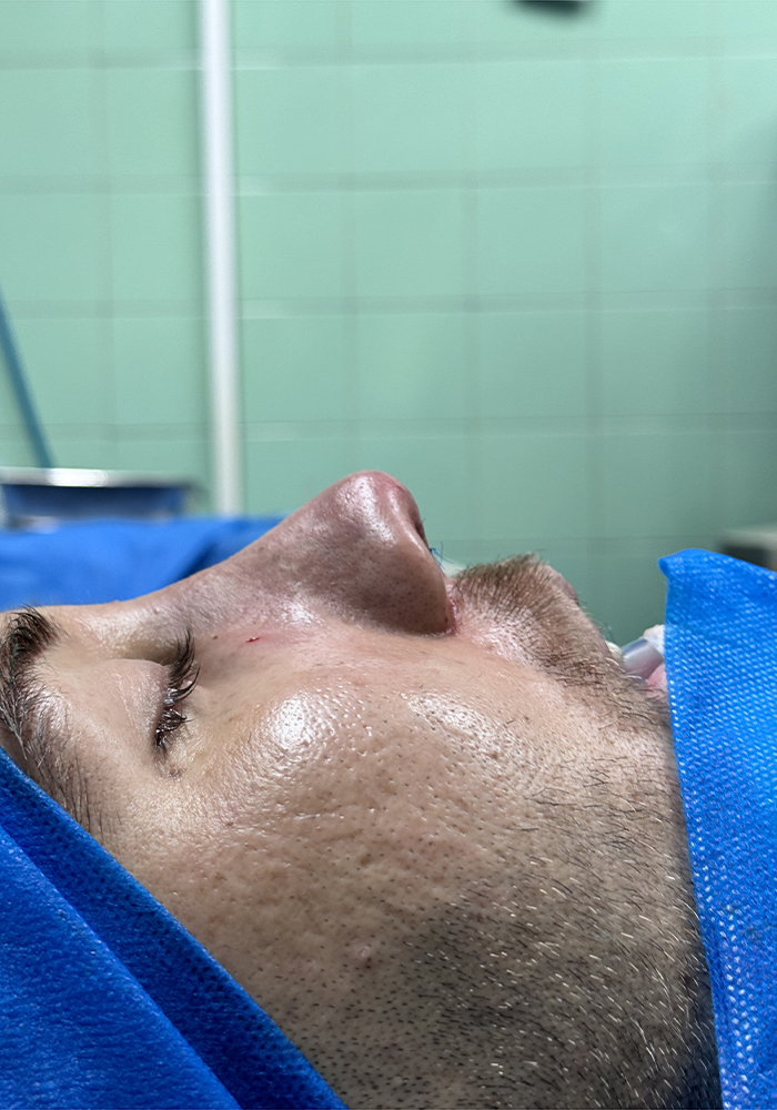 جراحی زیبایی بینی (رینوپلاستی)