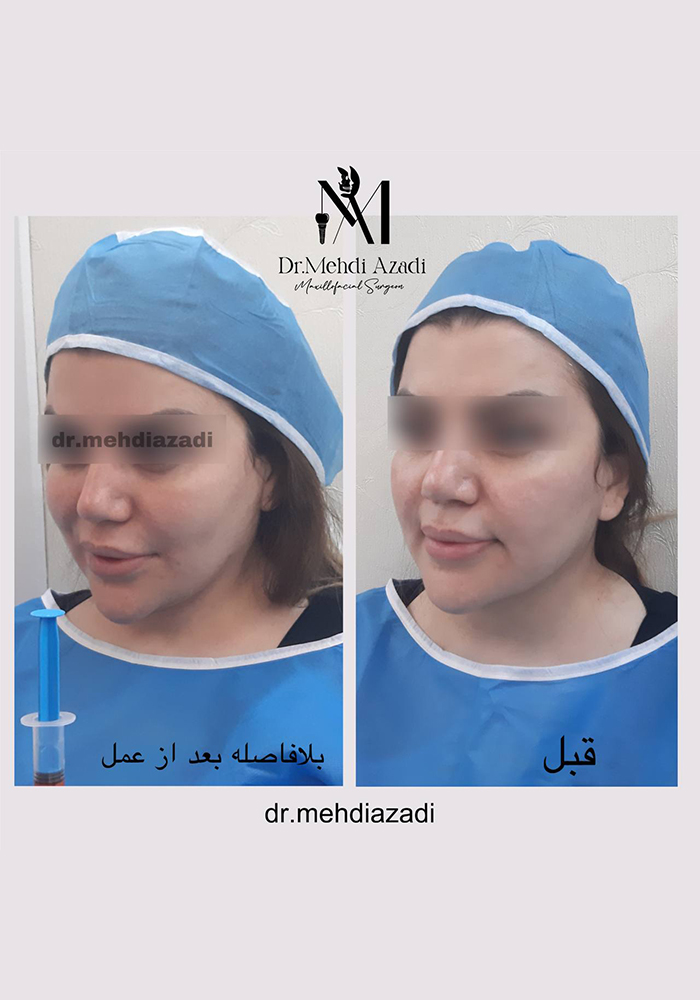 جراحی باکال (بوکال فت)