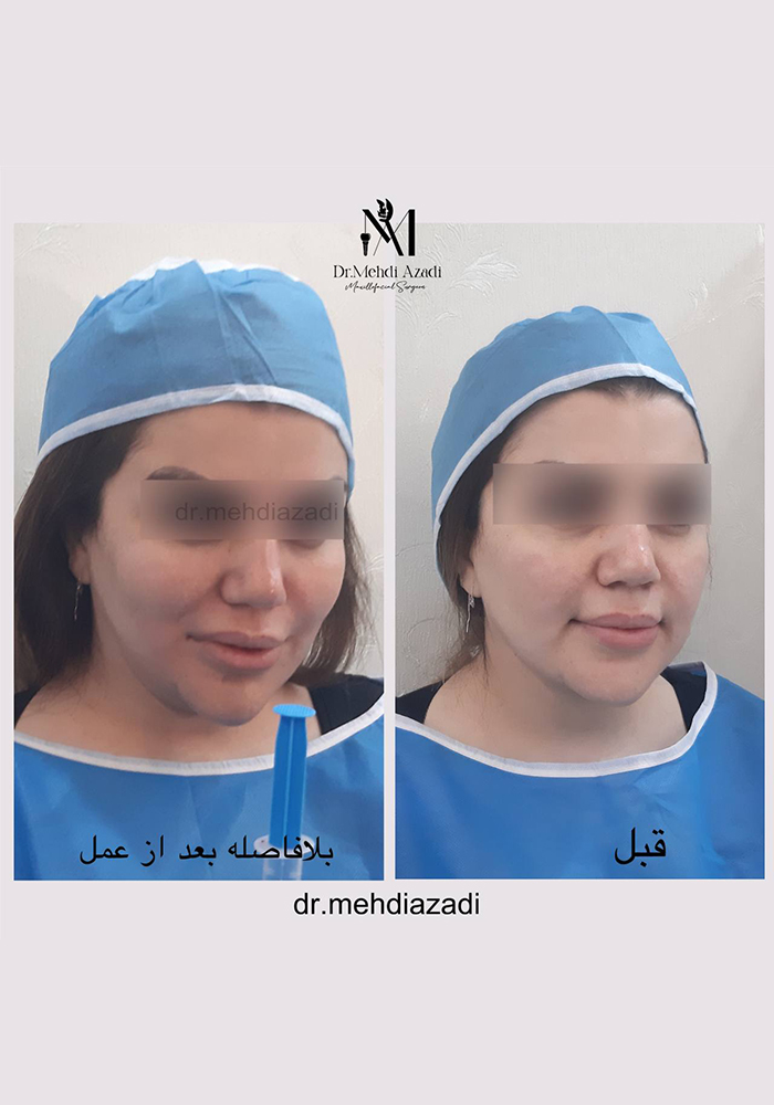 جراحی باکال (بوکال فت)
