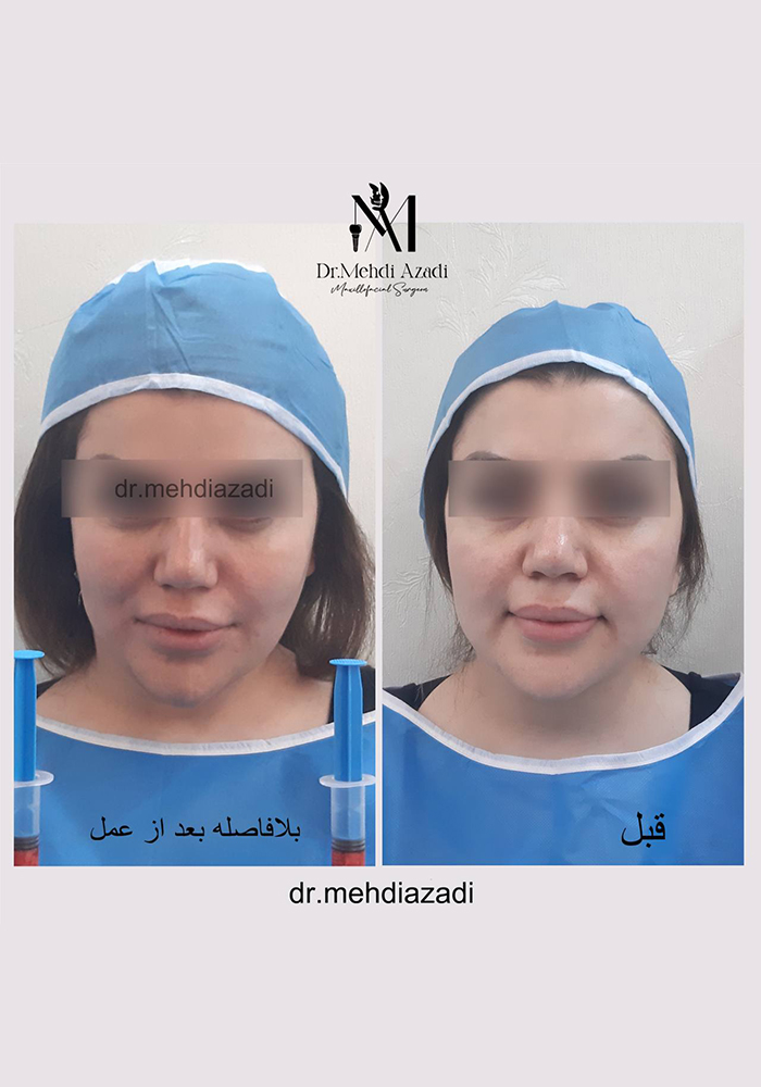 جراحی باکال (بوکال فت)