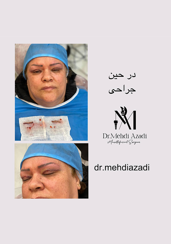 جراحی پلک (بلفاروپلاستی)