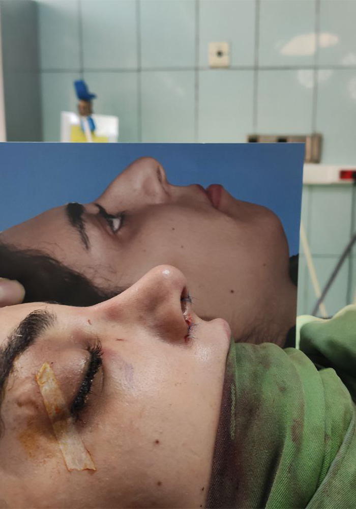 جراحی زیبایی بینی (رینوپلاستی)