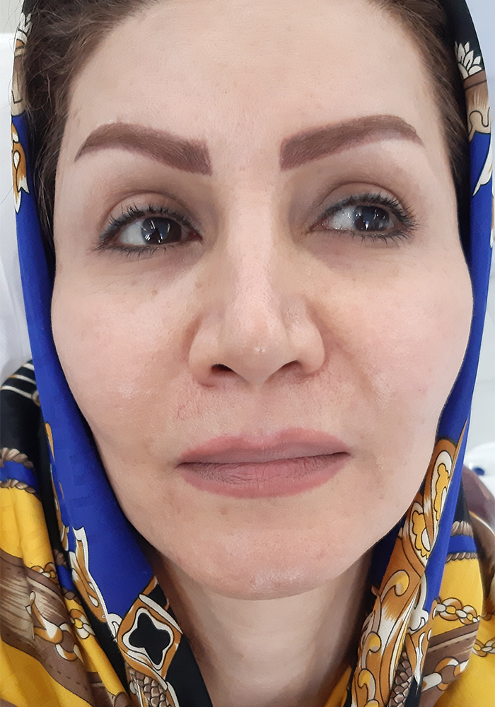 تزریق فیلر و چربی صورت