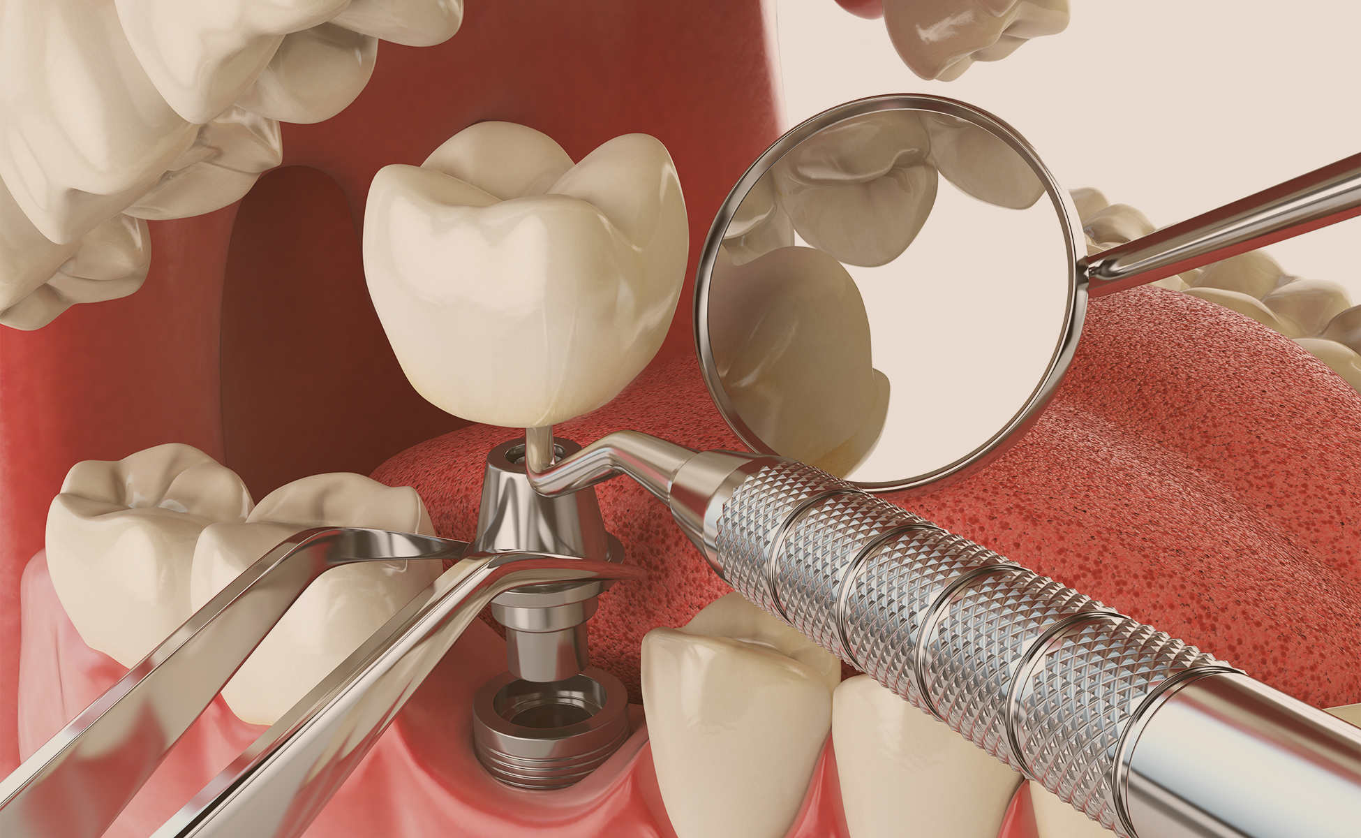 جراحی ایمپلنت