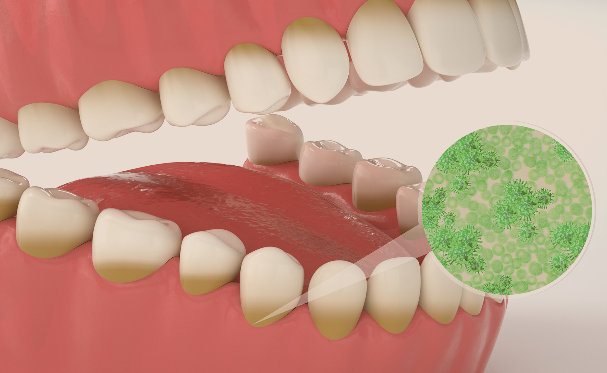 درمان عفونت‌های دندانی